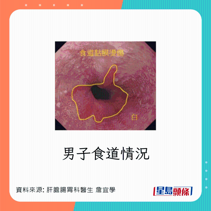 男患者食道灼傷，可惡化成食道癌