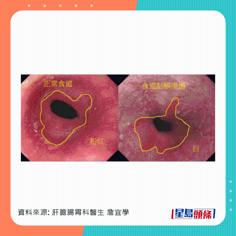 男患者食道灼傷，可惡化成食道癌