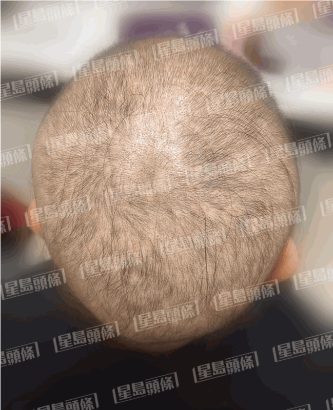 脫髮女子治療一個星期後的進度。（相片由註冊中醫師陳嬿珺提供）