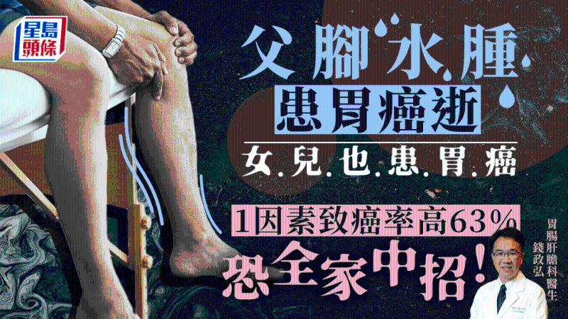父腳水腫患胃癌逝，女兒也中招，1因素致癌率高63%恐傳染全家