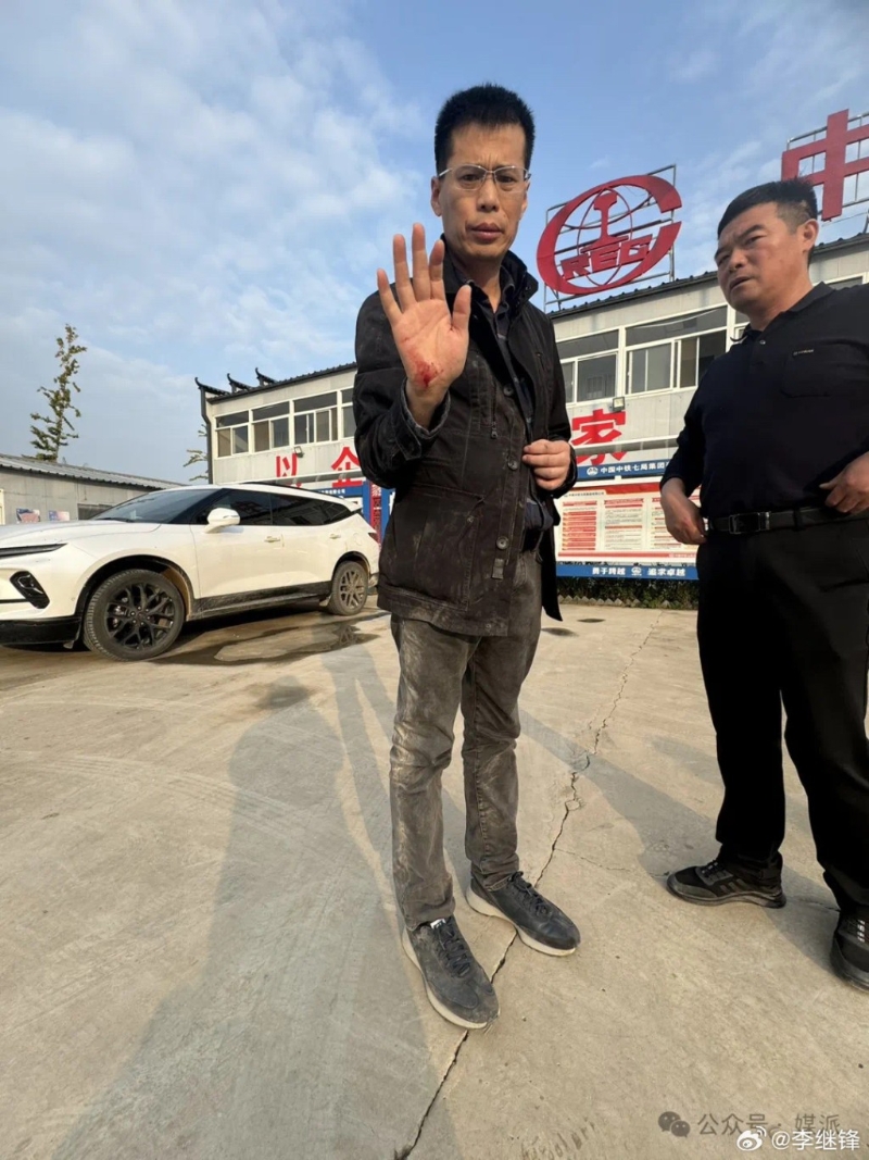 王文志右手受傷流血。(微博)