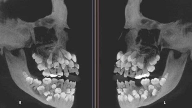11歲女童口內驚現81顆牙